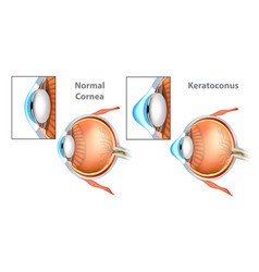 Keratoconus Cornea