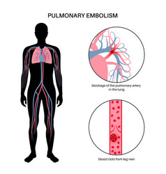 Pulmonary Embolism Disease