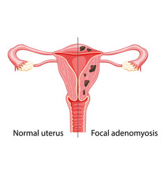 Focal Adenomyosis Human Anatomy Female