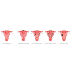 Adenomyosis Focal Diffuse Adenomyoma And Normal