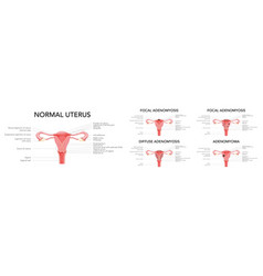 Adenomyosis Illness Set - Focal Diffuse