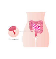 Appendicitis Medical