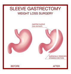 Vertical Sleeve Gastrectomy Weight Loss Surgery