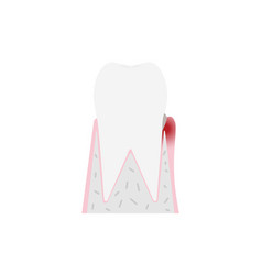 Stage Of Periodontal Disease Gingivitis