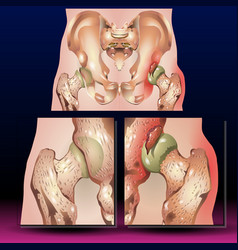 Pelvis Hip Fracture