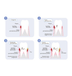 Periodontal Disease Progression 4 Stages