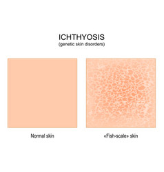 Ichthyosis Genetic Skin Disorders Normal