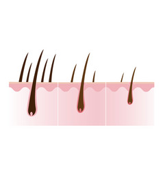 Step Of Hair Loss