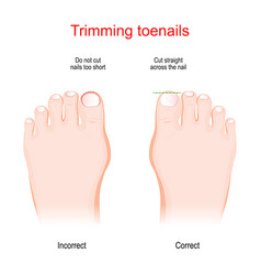 Trimming Toenails Incorrect And Correct