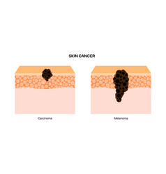 Melanoma And Carcinoma