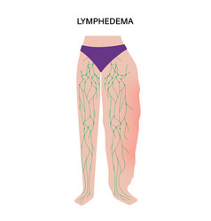 Lymphedema Leg Swelling