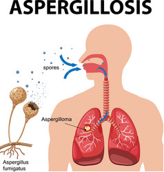 Diagram Showing Aspergillus Infection