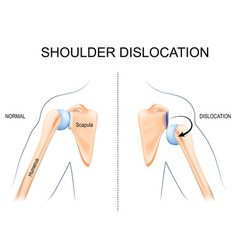 Shoulder Dislocation Humerus Bone Trauma