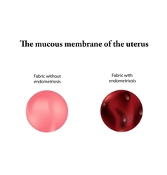 Endometriosis Adenomyosis The Endometrium