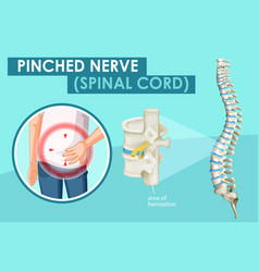 Diagram Showing Pinched Nerve In Human