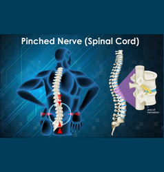 Diagram Showing Pinched Nerve In Human