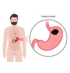 Stomach Cancer Concept