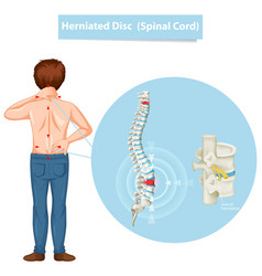 Diagram Showing Herniated Disc