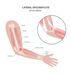 Lateral Epicondylitis Tennis Elbow