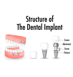 Dental Caries Stages Medical Poster Banner Vector Image