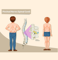 Diagram Showing Pinched Nerve In Human