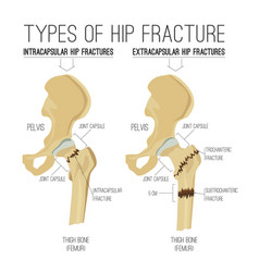 Types Of Hip Fracture