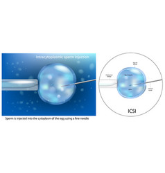 Procedure Of Intracytoplasmic Sperm Injection