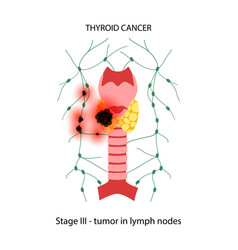 Thyroid Cancer Stages