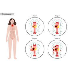 Thyroid Cancer Stages