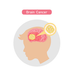 Brain Cancer Diagram