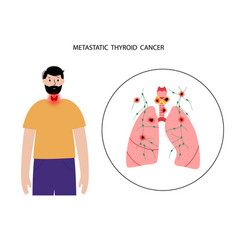 Thyroid Cancer Stages