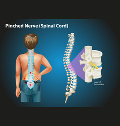 Diagram Showing Pinched Nerve In Human