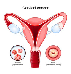 Cervical Cancer Carcinoma Malignant