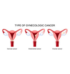 Type Of Gynecologic Cancer Ovarian Endometrial