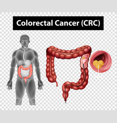 Diagram Showing Colorectal Cancer Crc