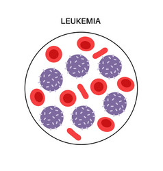 Leukemia Cancer Disease