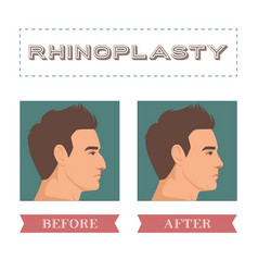 Rhinoplasty Concept Cosmetic