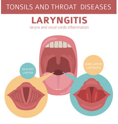 Tonsils and throat diseases laryngitis symptoms Vector Image