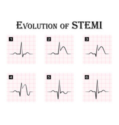 Ecg st elevation myocardial infarction stemi Vector Image