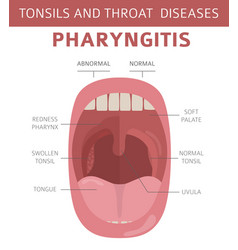 Tonsils and throat diseases tonsillitis symptoms Vector Image