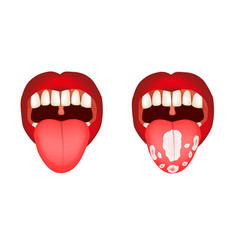 Candidiasis Tongue Thrush Inflammation