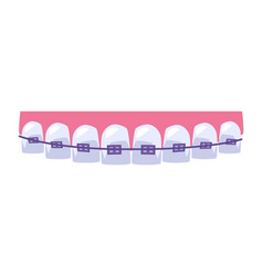 Teeth Straightening With Purple Dental Braces