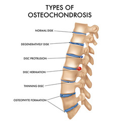 Spine Hernia Realistic Chart