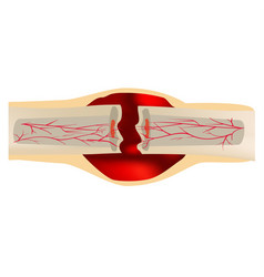 1 Stage Of Healing Bone Fracture Formation