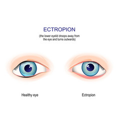 Ectropion The Lower Eyelid Droops Away From