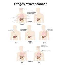 Stages Liver Cancer