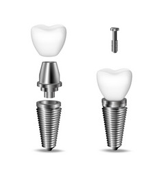 Realistic 3d Set Of Dental Implants Structural