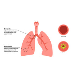 Bronchitis And Bronchiolitis