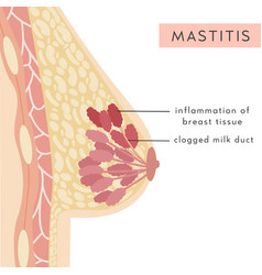 Medical Infographic Mastitis Disease Cross