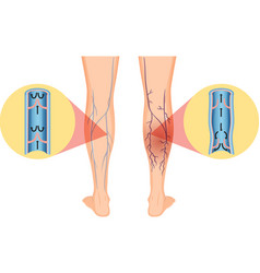 Human Legs With Varicose Vein